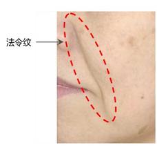 臉蛋色斑會(huì)成為黑色素瘤嘛