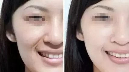 祛除黃褐斑大概要花多少錢呢-去黃褐斑要多少錢？