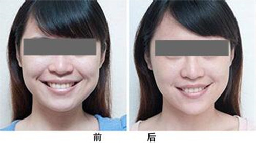 微創(chuàng)除皺手術(shù)的價(jià)格費(fèi)用是多少