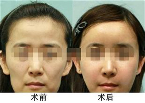 吸脂瘦臉手術(shù)的價(jià)格是在多少元左右？