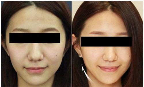 微創(chuàng)除皺術(shù)前為什么不可以服用阿司匹林藥物