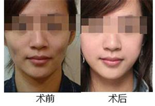 注射除皺后能不能熱敷