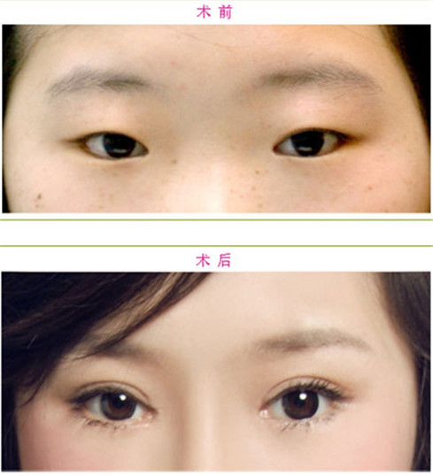 微創(chuàng)雙眼皮術(shù)后幾天時(shí)間能消腫