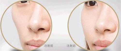 復(fù)合彩光除皺一般治療幾次效果較好