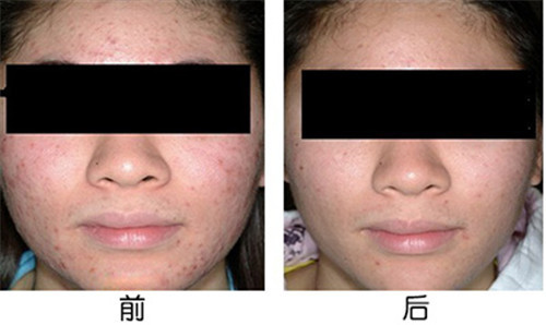 沈陽雀斑費用多少錢呢？