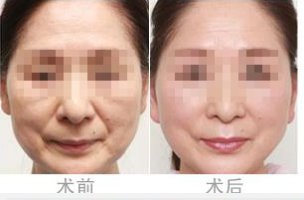 做磨削治療雀斑效果明顯嗎