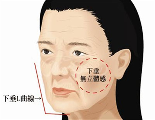 做射頻美容除去皺紋術(shù)后怎么護理
