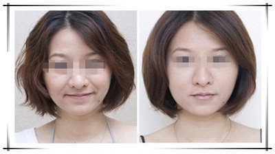 PicoWay超皮秒可以祛除咖啡斑嗎