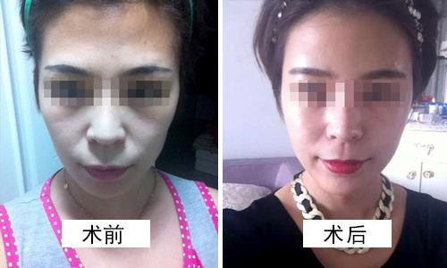 做面部皺紋消除有危險嗎