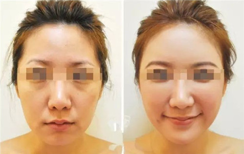 長沙botox生物除皺費用多少錢呢？