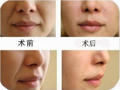上海冷凍治療老年斑多少錢呢？