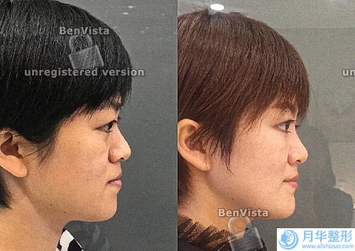 江蘇省中醫(yī)院激光價目表(江蘇省中醫(yī)院眼科激光怎么樣)
