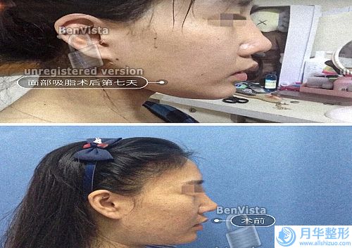 江蘇省中醫(yī)院激光價目表(江蘇省中醫(yī)院眼科激光怎么樣)