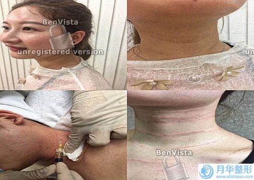 激光祛斑后哪些不能吃(激光祛斑后注意事項和飲食禁忌)