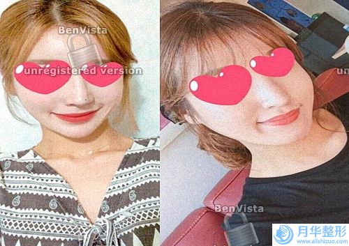 鐳射祛斑與激光區(qū)別(鐳射光祛斑好還是皮秒好)