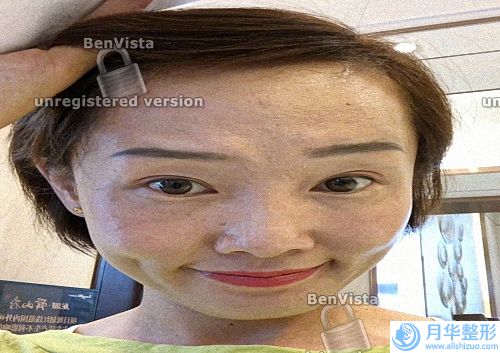 光子嫩膚手術(shù)治療雀斑效果（嫩膚手術(shù)效果好嗎）