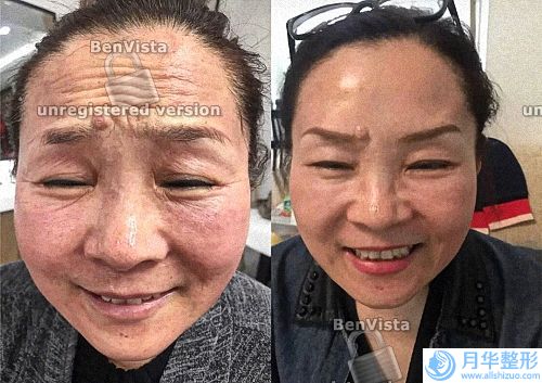 煙臺哪些方法能治療黃褐斑（什么方法快速去除黃褐斑呢）