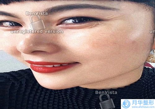 20歲女生長(zhǎng)斑正常嗎(22歲臉頰兩側(cè)長(zhǎng)斑)