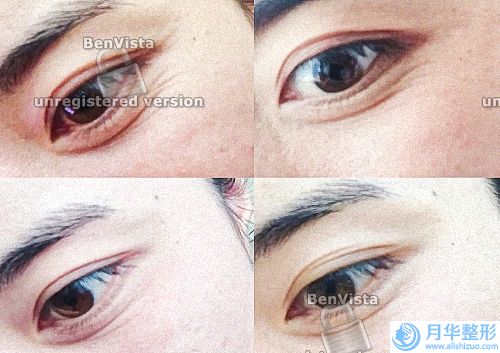 長斑一般都是什么情況造成的(15歲女孩臉上有斑可以用激光來去除嗎)