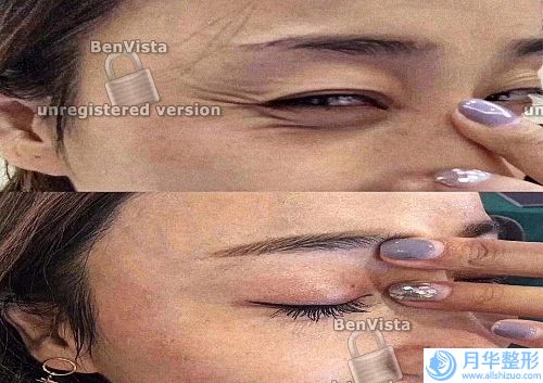 臉頰兩側(cè)有斑怎么辦(黃斑打針多少錢)