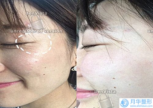 面部雀斑如何去除(怎么樣才可以防止長斑)