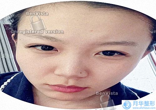 什么原因?qū)е履樕祥L斑(肝斑怎么去除比較有效)