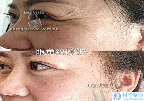 祛斑的價格是多少錢(e光可以祛斑嗎)