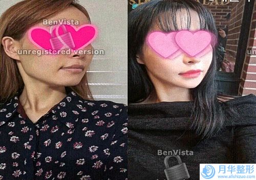 張掖去妊娠紋有副作用嗎(祛妊娠紋的產(chǎn)品有用嗎)