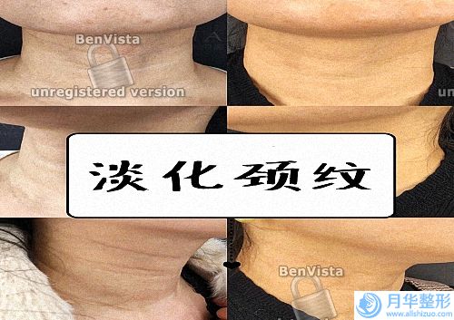 彩光嫩膚治療后需要注意些什么呢