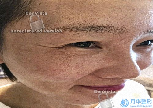 超聲刀除皺手術(shù)的價錢是多少