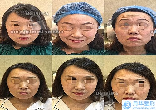 臉上為什么會長黃褐斑（長黃褐斑的原因）
