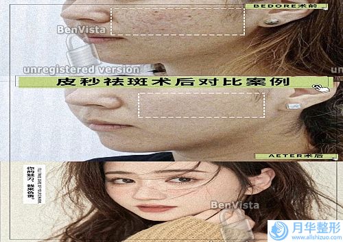 如何預防妊娠紋（如何去除妊娠紋）