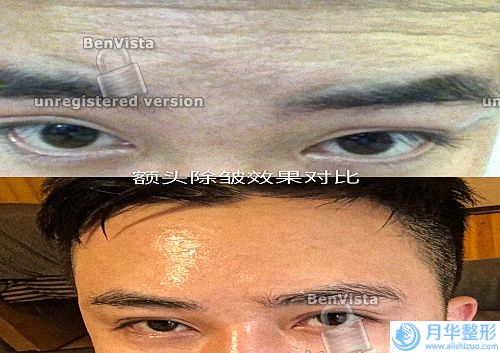 像束激光美膚嫩膚費用怎么樣，要多少錢呢