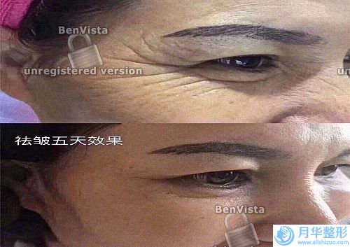 像束激光美膚嫩膚費用怎么樣，要多少錢呢