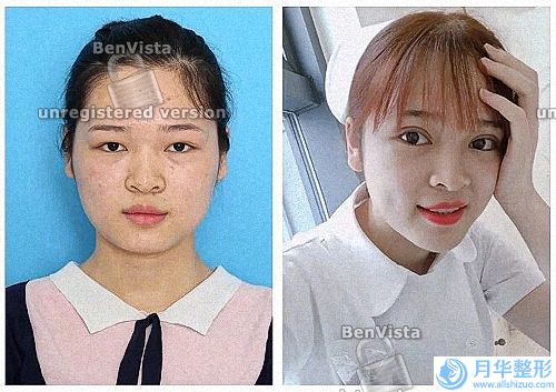 像素激光恢復過程