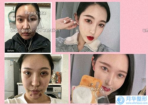 像素激光恢復過程