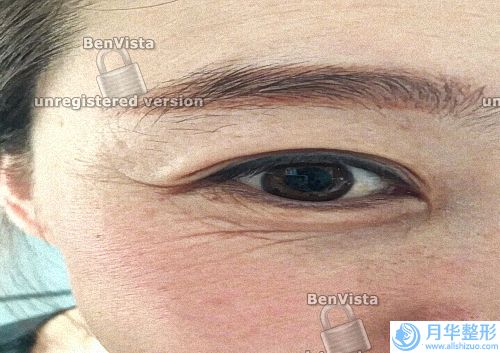 有什么方法可以有效去淡化妊娠紋嗎（如何去除淡化妊娠紋）