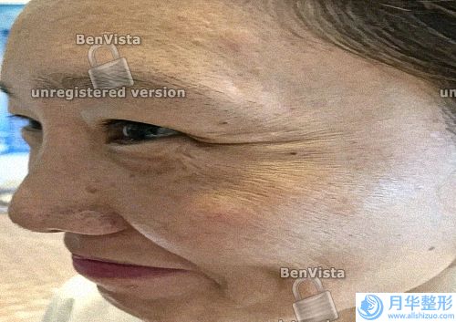 超全激光祛斑術(shù)后要注意什么？怎么知道適不適合做黃褐斑