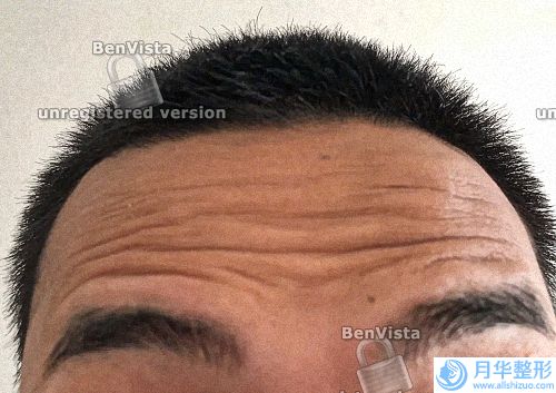 超全激光祛斑術(shù)后要注意什么？怎么知道適不適合做黃褐斑