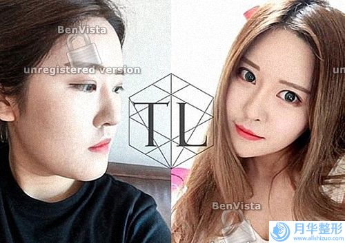 激光祛斑忌口一般不能吃什么(激光祛斑要恢復多久)