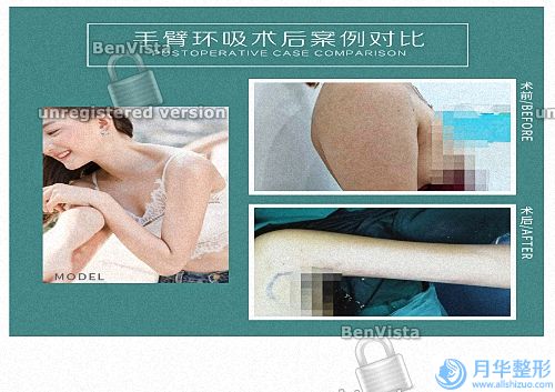 注射除皺哪里好(注射除皺好)