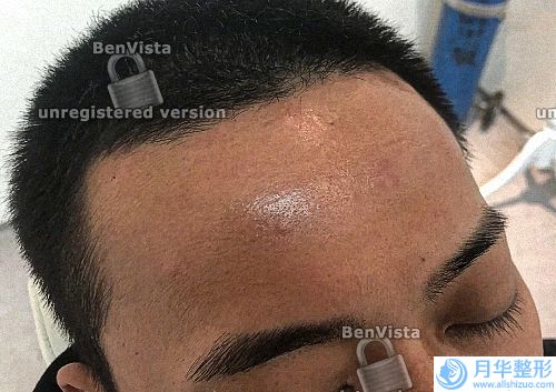 做魚尾紋大概多少錢呢(做眼線前后對比照片)
