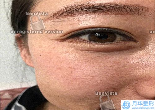 額頭上有抬頭紋怎么辦(額頭上的表情紋怎么去除)
