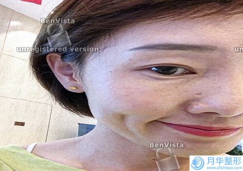保妥適除皺效果怎么樣(保妥適除皺多久打一次)