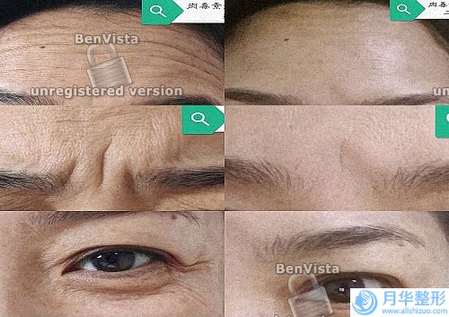 玻尿酸注射除皺貴嗎(玻尿酸和除皺針哪個(gè)貴)