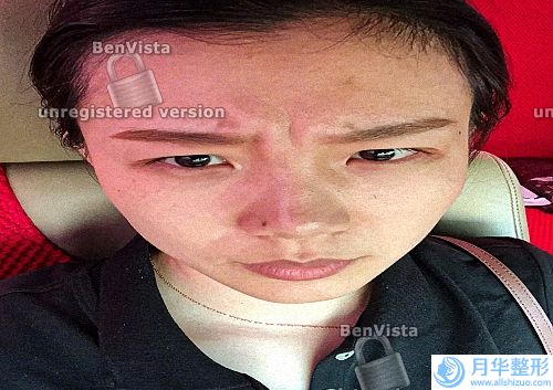 除皺瘦臉針后要注意什么(打瘦臉針后多久能敷面膜)