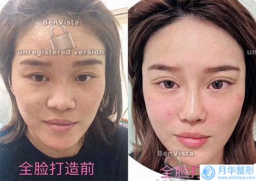 光子脫毛術(shù)前需要做哪些準(zhǔn)備？