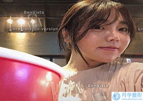 冰點(diǎn)激光脫腿毛效果好嗎