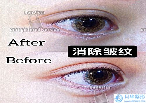 光子脫毛價格貴嗎