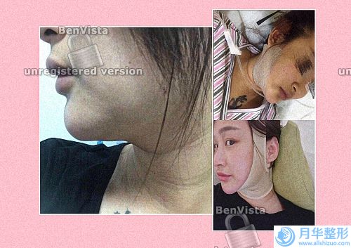 30歲臉上有很多絡(luò)腮胡，光子脫毛可以全部去干凈嗎
